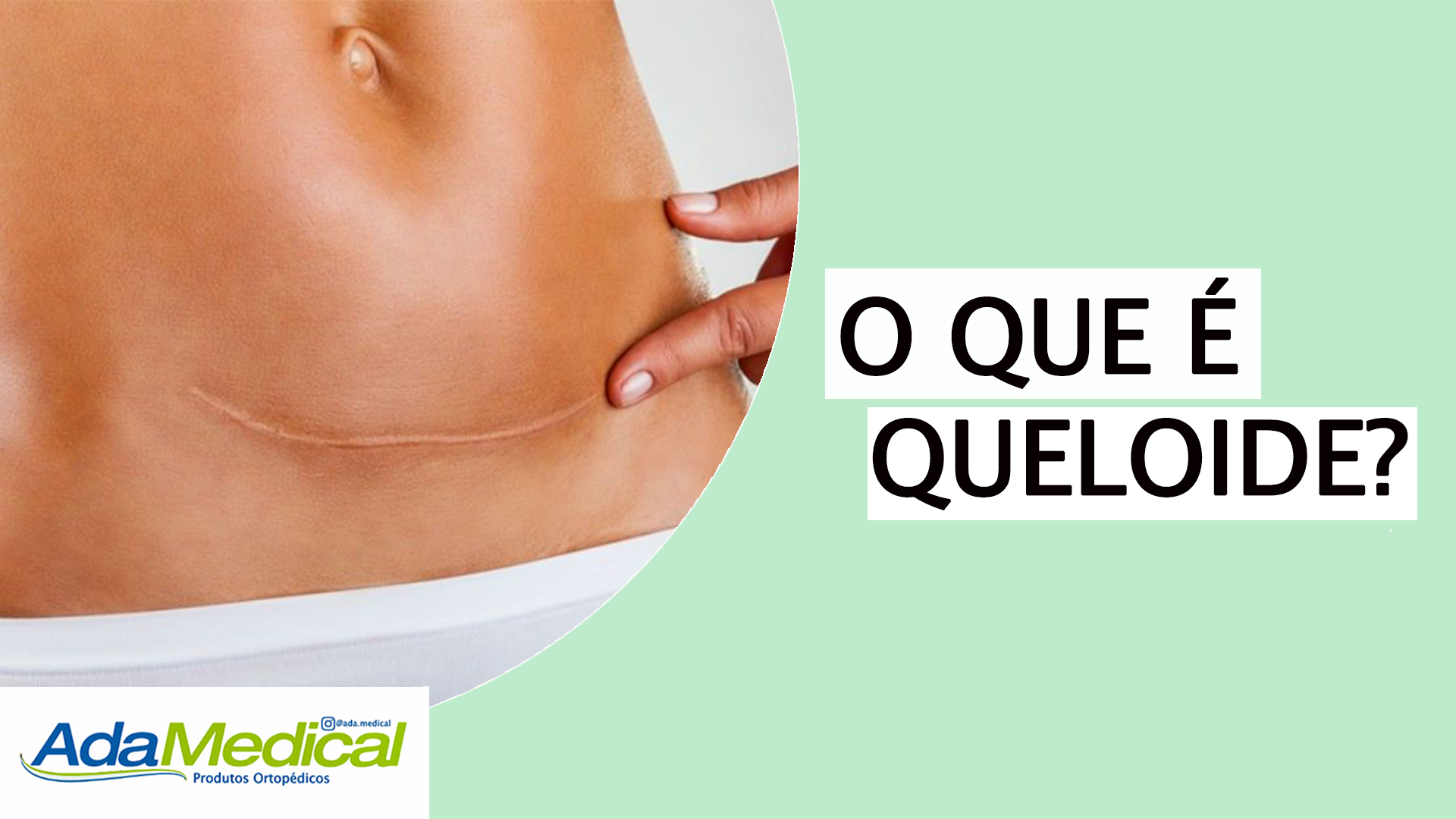 Afinal Queloide Tem Cura Ada Medical Blog